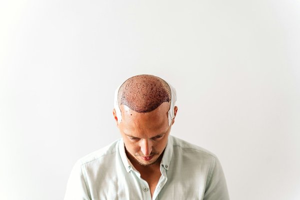 Ce qu’il faut savoir sur la transplantation cheveux